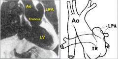 Truncus arteriosus
Single trunk arising from right and left ventricles, aligned over a VSD
Type I: main pulmonary artery arises from truncus
Type II and type III: individual right and left pulmonary arteries arise from truncus

Rastelli conduit:
Tre
