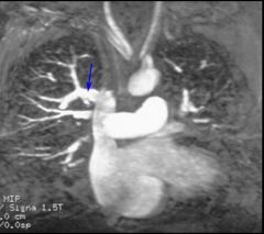 PAPVR
Case findings:
MIP: drainage of the right upper lobe pulmonary vein into SVC

Types:
Supracardiac: draining into SVC, brachiocephalic vein, or azygous vein
Cardiac: draining into RA or coronary sinus
Infracardiac: draining into IVC
Called sc