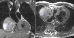 Pericardial hematoma
Case findings:
Mass in the left atrioventricular groove, compressing the LA and LV
Acute angle of pericardial interface with the mass, indicating an intrapericardial location 
Signal is intermediate T1, without enhancement
Not sh