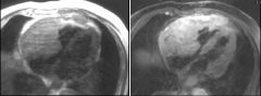 Lymphoma
Case findings:
Mediastinal mass that encases the distal trachea and bilateral mainstem bronchi 
Mass invades the roof of the left atrium 
Enhances homogeneously

DDX:
Thrombus
Thrombus is darker on GRE sequences than muscle 
Tumor on GRE