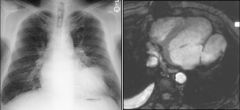 Ventricular aneurysm
Case findings:
Pericardial effusion with high T1 (serosanguinous)
Left ventricular true aneurysm 

True ventricular aneurysm
Large segment of nonviable myocardium
Focal wall thinning and is deformed during diastole and dilates 