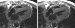 Constrictive pericarditis
Case findings:
Pericardium is thickened over the RA and TV
Pericardium is clearly identified between two layers of fat (pericardial fat and epicardial/subpericardial fat)

Etiology:
Cardiac surgery, radiation therapy
Tuber