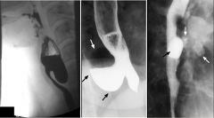 Pharyngeal pouch

Case findings: 
Contrast-filled cavity at the posterior wall of the esophagus 

Arises between the superior and the middle pharyngeal constrictors (congenitally weak point of the pharyngeal wall)

Esophageal diverticula:
Pulsion 