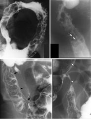 Crohn’s

Case findings: 
Deep and superficial linear ulcerations and small bowel wall thickening near the terminal ileum
Fistula track

Features:
Deep and superficial linear ulcerations
Cobblestoning
Bowel wall thickening, strictures, skip lesion