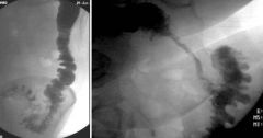 Diverticulitis
Case findings:
Irregular bowel wall thickening, with narrowing of the sigmoid lumen
Mucosal pattern preserved (implies a benign process)