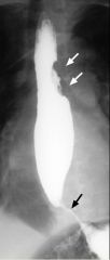Achalasia

Case findings:
Dilated, aperistaltic esophagus that tapers abruptly to a narrowed, fixed lumen
Tapering is concentric and the lumen contour is absolutely smooth

Primary achalasia:
Result of degeneration of the myenteric plexus innervati