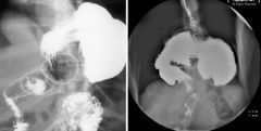 Gastric volvulus

Mesenteroaxial (this case): 
Stomach has rotated about the gastrohepatic ligament (lesser omentum)

Organoaxial:
Stomach flips superiorly parallel to the longitudinal axis of the organ
Greater curvature lies superior to the lesser