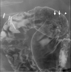 Erosive duodenitis

Multiple aphthoid-like small ulcers in the duodenal cap  tiny barium collections surrounded by radiolucent halos of edema

Erosions are seen both en face (arrows) and in profile (arrowhead)