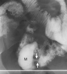Meckel’s diverticulum

Case findings:
Smooth-contoured saccular outpouching from the antimesenteric wall of a RLQ ileal loop
No folds are seen in the outpouching

Occurs at obliterated omphalomesenteric duct
Contains all layers of the bowel wall
E