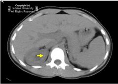 Medullary nephrocalcinosis

CT: faint calcifications within the renal medulla 
MC etiology:
Hyperparathyroidism 
Medullary sponge kidney (renal tubular ectasia)
RTA type I (distal convoluted tubules)

LC etiology:
Hypervitaminosis D 
Milk-alkali
