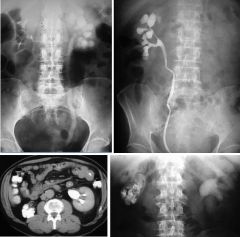 Renal tuberculosis

Case findings:
Small densely rim calcified left kidney due to longstanding tuberculosis 

Putty kidney: small calcified end stage kidney resulting from autonephrectomy due to renal TB 
Papillary necrosis
Calyceal dilatation, amp
