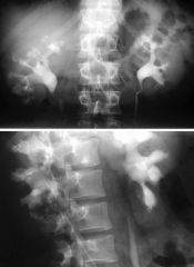 Medullary sponge kidney

Case findings:
Bilateral nephrocalcinosis

Features:
Tubular ectasia with linear collections of contrast identified within medullary pyramids
With time, these will progressively dilate and form cystic cavities
Cavities res