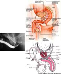 Urethral stricture 

Etiology:
MC used to be gonococcal
Periurethritis: indwelling urethral catheters 
Urethritis

Inflammatory strictures in bulbar urethra, which is the most dependent part and contains the greatest number of paraurethral glands

