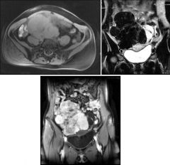 Axial fat-suppressed T1-weighted 
Coronal T2-weighted post-Gd
Coronal fat-suppressed T1WI post-Gd