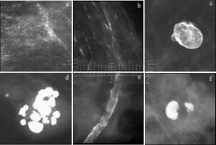 Benign microcalcification
Plasma cell mastitis (secretory calcifications)
Fat necrosis
Fibroadenoma
Vascular
Benign calcifications