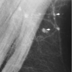 Rheumatoid arthritis

Case findings:
Enlarged dense axillary lymph nodes

DDX of enlarged axillary lymph nodes:
BCA with lymph node metastasis
Lymphoma
HIV
RA
TB, sarcoidosis
Benign reactive nodal hyperplasia

Metallic deposits in axillary no