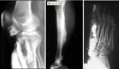 Melorheostosis 

Case findings:
Multiple areas of increased bone density 
Marked thickening of the lateral femoral cortex, which has a somewhat undulating medial margin 
Dripping wax appearance to the margins of the hyperostotic bone in the 2nd - 4th