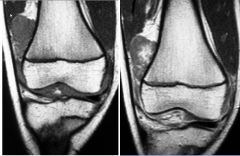 Pigmented villonodular synovitis (PVNS)

Proliferative disorder affecting synovium of joints, bursae, and tendons
Dense hemorrhagic effusion
Hemosiderin deposition

Well-defined erosions 
Nodular synovial masses in a juxta-articular distribution (l