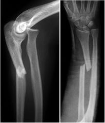 Essex-Lopresti fracture

Comminuted and displaced fracture of the radial head AND
Subluxation or dislocation of the DRUJ 
Due to longitudinal compression force 

Monteggia fracture

Fracture of the ulna and dislocation of the radial head
Monteggi