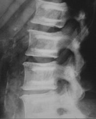 Osteopetrosis (marble bone disease, Albers-Schonberg)

Types: congenital AR lethal, tarda AD benign

Symmetrical generalized dense bones (lack of cortical and medullary differentiation)
Bone-in-bone appearance in spine and long bones
Sandwich verte