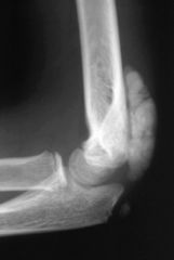 Tumoral calcinosis

Small calcified nodules progress to large multilobular calcific deposits in periarticular tissues
MC on extensor surfaces
Single joint involvement