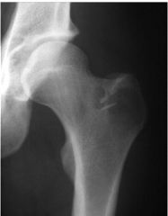 Giant cell tumor

Osteolytic eccentric, epiphyseal extension from metaphyseal origin
Intermediate aggressiveness with poorly defined margins and no rim of sclerosis
MC about knee, 50% recurrence 
After irradiation: chance of malignant transformation 