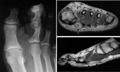 Fibrolipomatous hamartoma (neural fibrolipoma)

Case findings:
Axial proton-density MR image of the wrist: heterogenous mass within the carpal tunnel
Mass contains fat, displaces the flexor tendons and causes bowing of the flexor retinaculum 

Tumo