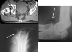 Lipohemarthrosis

Mixture of fat and blood in a joint cavity following trauma 
Presence of a fat-fluid level is nearly diagnostic of a fracture, even when that fracture is radiographically occult 

Posterior dislocation of the right hip with blood an