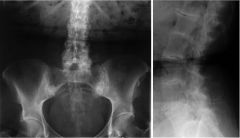 Onchronosis (alkaptonuria)

Spondylitis and arthritis of large joints (knees, shoulders, hips)
Deposition in cartilage  synovial thickening
Spine:
Degenerative disc disease 
Resembles ankylosis spondylitis
Disc space calcification 

Pathognomoni