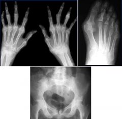 Rheumatoid arthritis

Features:
Bilaterally symmetrical
Proximal joints: MCP, PIP, ulnar styloid
Periarticular demineralization

May lead to secondary DJD:
Marked narrowing of joint space
Intact articular cartilage
Little or no sclerosis

RA f