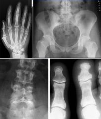 Psoriatic arthritis

Case findings:
Hand: 
Periostitis (arrows)
STS of 3rd digit
Erosions at margin of DIP joint 

Fingers:
Marginal and central erosions (arrows) 
Intra-articular ankylosis
Flexion contractures at DIP joints 

MC involves DIP