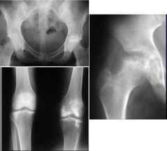Multiple bone infarcts from sickle cell disease