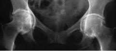 Acetabular protrusio

Diagnosis: Paget’s
Medial wall of acetabulum projects medial to ilioischial line (> 6 mm women, > 3 mm men)

Primary protrusio (Otto pelvis): 
Affects middle-aged women 
Familial protrusion of the acetabulum, bilateral

Seco