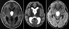 Craniopharyngioma

Case findings:
T2 and T1 weighted (pre-Gd): demonstrate a heterogeneous primarily cystic appearing mass in the suprasellar cistern
Focal regions of decreased signal intensity, which may be secondary to calcifications

Post-Gd T1 w