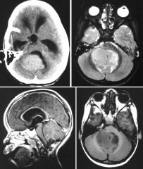 Ependymoma

CT: 
Obstructive hydrocephalus
Obliteration of the 4th ventricle
Internal calcifications

MRI:
Presence of flow voids
Mass extends laterally through the right foramen of Luschka
Heterogeneous enhancement
Marked mass effect on medull