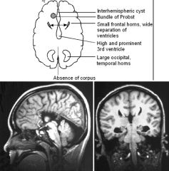 Agenesis of the corpus callosum

Findings:
High-riding 3rd ventricle 
Frontal horns C-shaped on coronal view 
Colpocephaly: dilated occipital horns
Parallel orientation of lateral ventricles: median bundles of Probst do not cross hemispheres

Asso