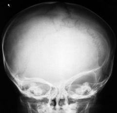 Trigonocephaly 

Case findings: 
Abnormal “wedge shaped” or “triangular” appearance to the frontal bone of the skull 
Premature closure of the metopic suture 

Craniosynostosis 

Scaphocephaly (dolichocephaly): premature closure of the sagittal su