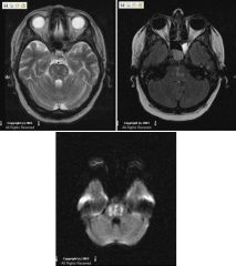 Axial T2-weighted
Axial FLAIR
Axial DWI