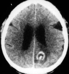 Cryptococcosis

Case findings:
Multiple areas of calcification 
Enhancement of meninges in the basal cisterns bilaterally 

MC CNS mycotic infection 

DDX basilar meningeal enhancement:
MC TB, fungal (cryptococcus), pyogenic( MC on convexity), cy