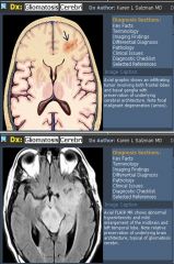 Gliomatosis cerebri (diffuse cerebral gliomatosis)

Case findings: expanded hemisphere, with sulcal effacement and ventricular compression, with an inhomogeneous diffuse hyperintensity on T2-weighted images mainly involving white matter 

Infiltrativ