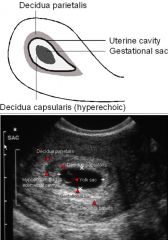 Early intrauterine pregnancy

Double decidual sac sign: early sign if IUP
Placenta: chorionic leave (blood supply) + decidual basalis 
Decidual parietalis and capsularis 

Double decidual sac sign

Decidua parietalis: hyperechoic
Hypoechoic fluid