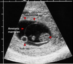 Early intrauterine pregnancy

Amniotic cavity: 
Contains embryo and fuses with chorion by 14-16 weeks

Yolk sac: 
Outside amniotic cavity but within chorionic cavity
Connected to primitive gut by omphalomesenteric (vitelline) duct
Umbilical cord f