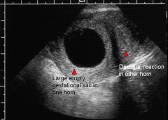 Empty gestational sac

Diagnosis: 
Empty gestational sac in bicornuate uterus
Empty gestational sac: does not contain a yolk sac or embryo (fetal pole)

DDX:
Early normal IUP (if MSD < 8 mm)
Blighted ovum (if MSD > 8 mm)
Other names: embryonic de