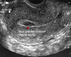 Pseudogestational sac

Located centrally, unlike true gestational sac which is eccentric
Does not have a yolk sac
Absent double decidual sign

IUP normal findings

Yolk sac (TV): visible if MSD > 8 mm
Fetal pole/embryo (TV): visible if MSD > 18 m