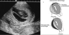 Subchorionic hemorrhage

Subchorionic hemorrhage: MC site of placental abruption
Acutely, may be hyperechoic and as the hemorrhage begins to liquify and resorb becomes more hypoechoic

DDX for hypoechoic subchorionic hemorrhage:
Amniotic band
Synec
