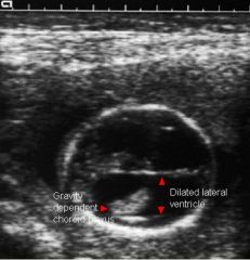 Ventriculomegaly

Dangling choroid plexus in lateral ventricle
Lateral ventricles > 10 mm

Etiology of hydrocephalus:
MC spina bifida
Aqueductal stenosis
Dandy-Walker malformation
Encephalocele
Chiari malformation