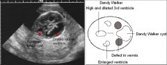 Dandy-Walker syndrome

Associated with: 
Agenesis of the corpus callosum
Encephalocele

DW complex:
Includes DW malformation and its variants
In utero insult to the 4th ventricle, which leads to complete or partial outflow obstruction of CSF
Cyst