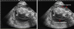 Cystic hygroma

MC in posterior triangle
MC multiple cysts of varying sizes separated by septae

DDX: occipital encephalocele

Associated with:
Turner’s syndrome
Trisomy 21, 18, 13
Fetal alcohol syndrome