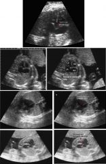 Ventricular septal defect
Normal fetal heart
Endocardial cushion defect
Aortic stenosis