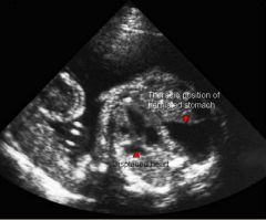 Omphalocele

Midline anterior abdominal wall defect
Herniation of intra-abdominal contents into the base of the umbilical cord
Herniated contents covered by peritoneum, amnion, and Wharton’s jelly
High incidence of associated anomalies 

Gastrochis